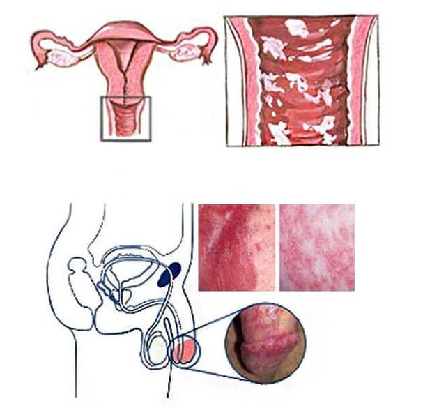 Female and male genital candidiasis as the cause of pathological discharge