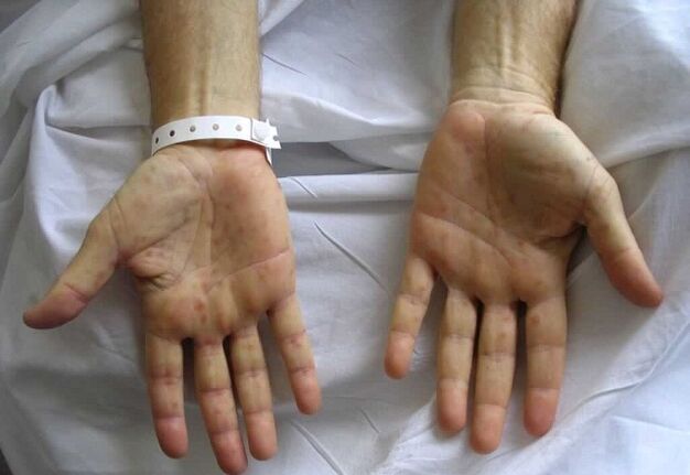 Syphilis on the hands as a cause of pathological discharge from the penis